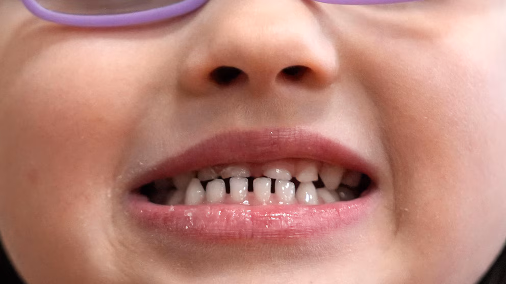 FDA Restricts Kids’ Fluoride Supplements Over Health Risks