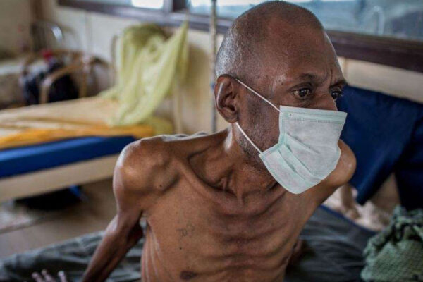 Global TB Report 2025 shows tuberculosis still kills over 1.2 million people annually